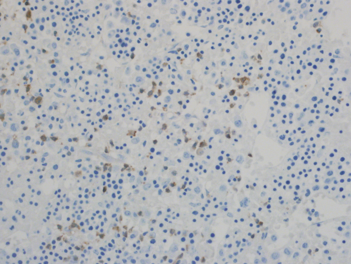 Bone Marrow Biopsy, Tdt, 40X